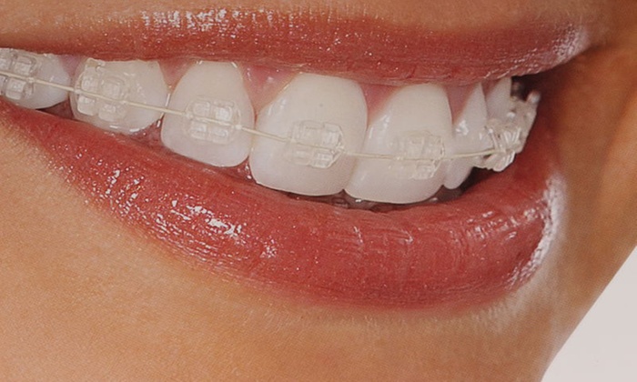 Featured image of post Imagens De Dente Com Aparelho / Agende sua consulta em um clique hoje mesmo com o consulta ideal.