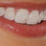 Dentista esclarece mitos e verdades sobre o uso dos aparelhos ortodônticos