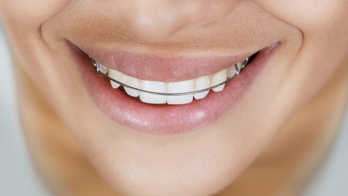 contencao-nos-dentes